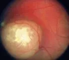 Retinoblastom