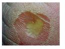 Stuccokeratosis