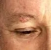 Trichoepithelioma