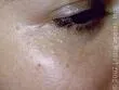 Syringoma