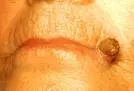 Cornu cutaneum