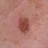 Keratosis actinica