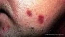 Granuloma pyogenicum