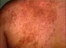 Naevus sebaceus