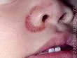 Dermatitis seborrhoica infantum