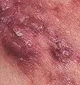 Acne necrotica