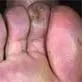 Perniones (promrzline)
