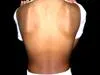 Hydroa vacciniforme