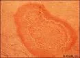 Erythema anulare centrifugum