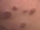 Erythema elevatum et diutinum