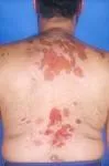 Pemhigus erythematosus