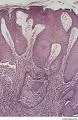 Pemphigus chronicus benignus familiaris
