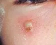 Pustulosis acuta generalisata