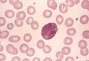 Erythrodermia ichthyosiformis congenitalis bullosa