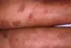 Erythrokeratodermia figurata variabilis