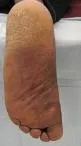 Keratosis palmoplantaris transgrediens