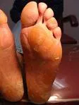 Keratosis palmoplantaris diffusa