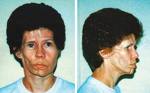 Hemiatrophia faciei progressiva