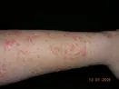 Erythrodermia symmetrica progressiva