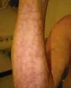 Livedo reticularis