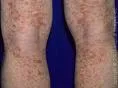 Capillaritis alba