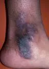 Lichen simplex chronicus