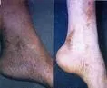 Dermatitis hypostasica