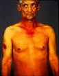 Thrombophlebitis migrans