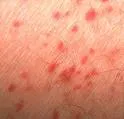 Purpura eczematoides