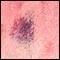 Urticaria - vasculitis
