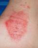 Numularni ekcematoidni dermatitis