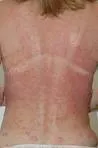Fototoksične dermatoze