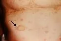 Pityriasis lichenoides chronica