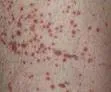Vasculitis allergica leukocytoclastica