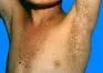 Keratosis follicularis
