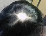 Alopecia areata (Ćelavost na pečate)