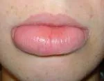 Granulomatozni heilitis