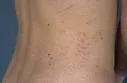 Angiokeratoma corporis diffusum