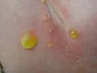 Herpetiformni impetigo
