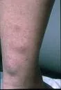 Myxoedema circumscriptum symmetricum praetibiale