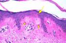 Amyloidosis cutis maculos