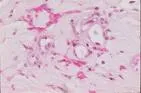 Amyloidosis cutis nodularis atrophicans