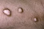 Calcinosis cutis dystrophica