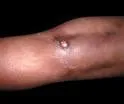 Calcinosis cutis circumscripta