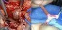 Aneurizme visceralnih arterija