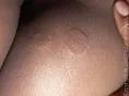 Granuloma anulare