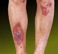 Necrobiosis lipoidica (diabeticorum)