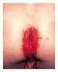 Dermatitis perianalis