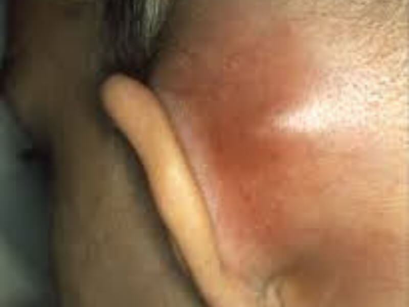 Mastoiditis latens