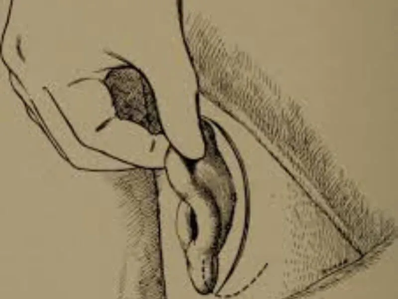Hronični mastoiditis
